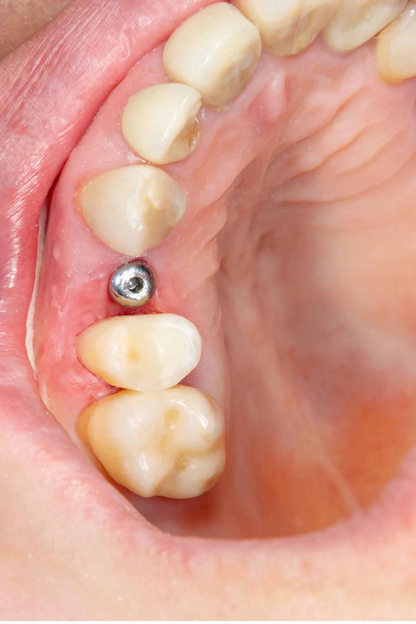 Close-up van een tand-implantaat met kroon naast natuurlijke tanden